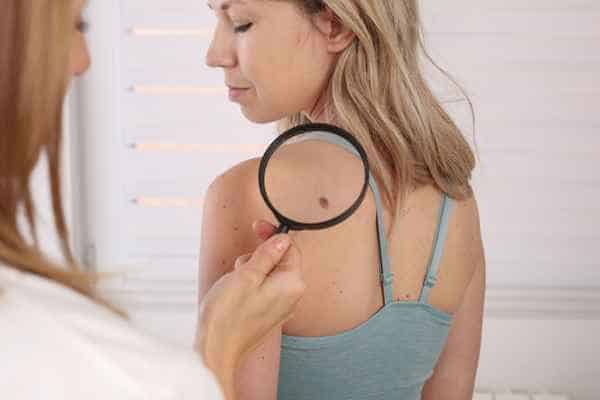 What Are Traditional Skin Lesion Removal Methods West Bromwich?