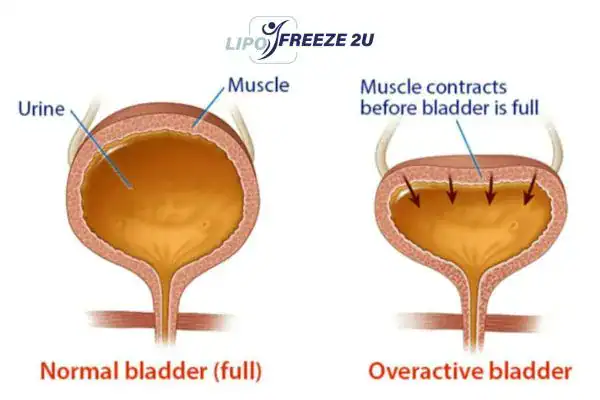 diagram of overactive bladder treatment West Bromwich