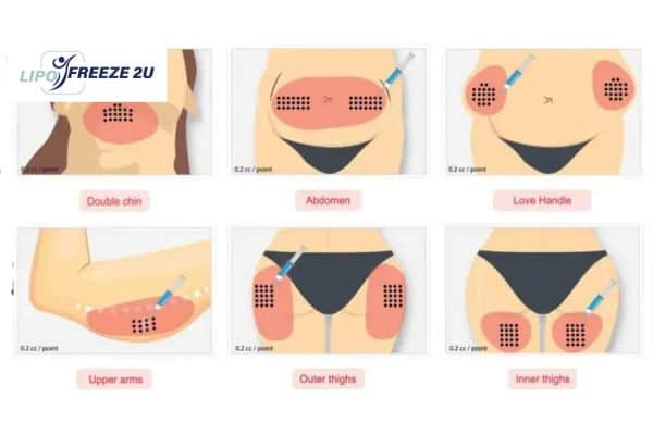 Benefits of Choosing Aqualyx for Fat Reduction West Bromwich