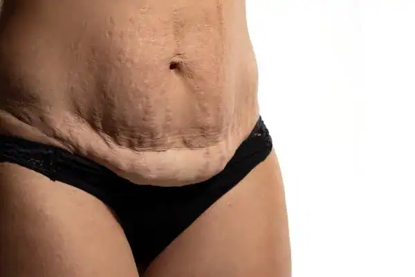 loose skin after weight loss injections West Bromwich