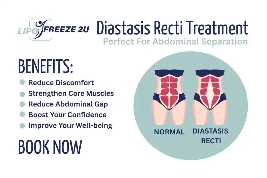 Benefits of body toning treatment West Bromwich for Diastasis recti