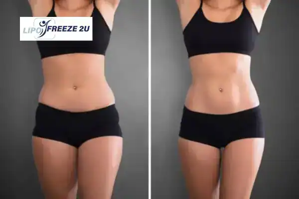 How Can LIPO FREEZE 2U Support Your Post-Pregnancy Body Recovery West Bromwich?