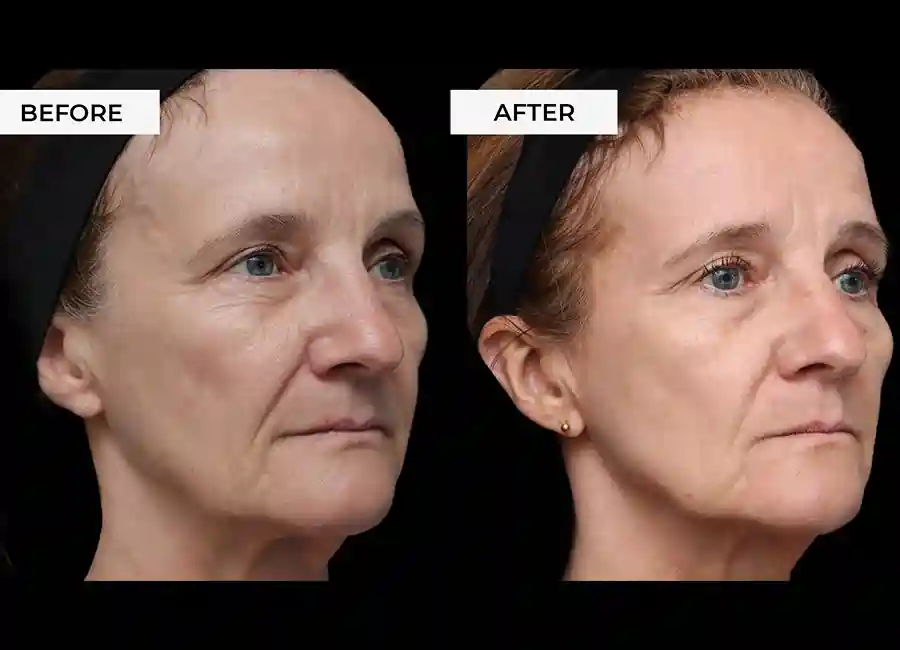 How Many RF Microneedling Sessions Will You Need to See a Difference West Bromwich?